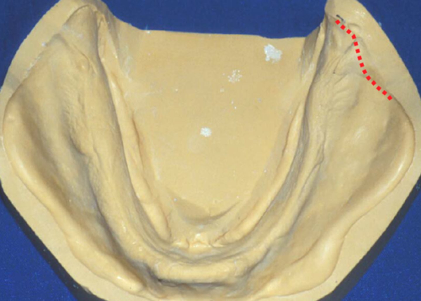 <p>where distobuccal flange of t3he denture should be contoured to allow freedom for the superior and medial buccinator movements.</p>