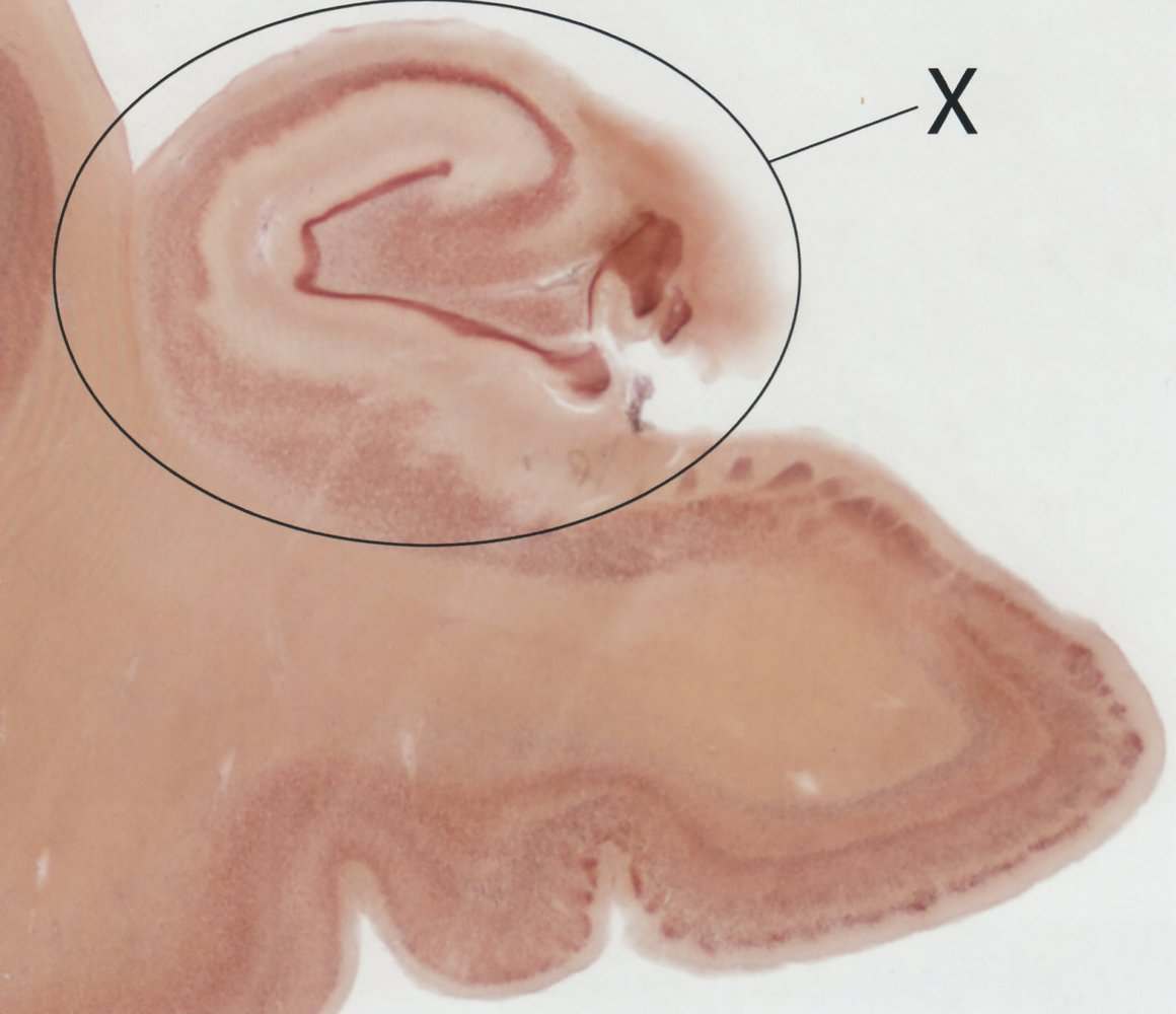 <p>E. Foot of the hippocampus (Pes hippocampi)</p>