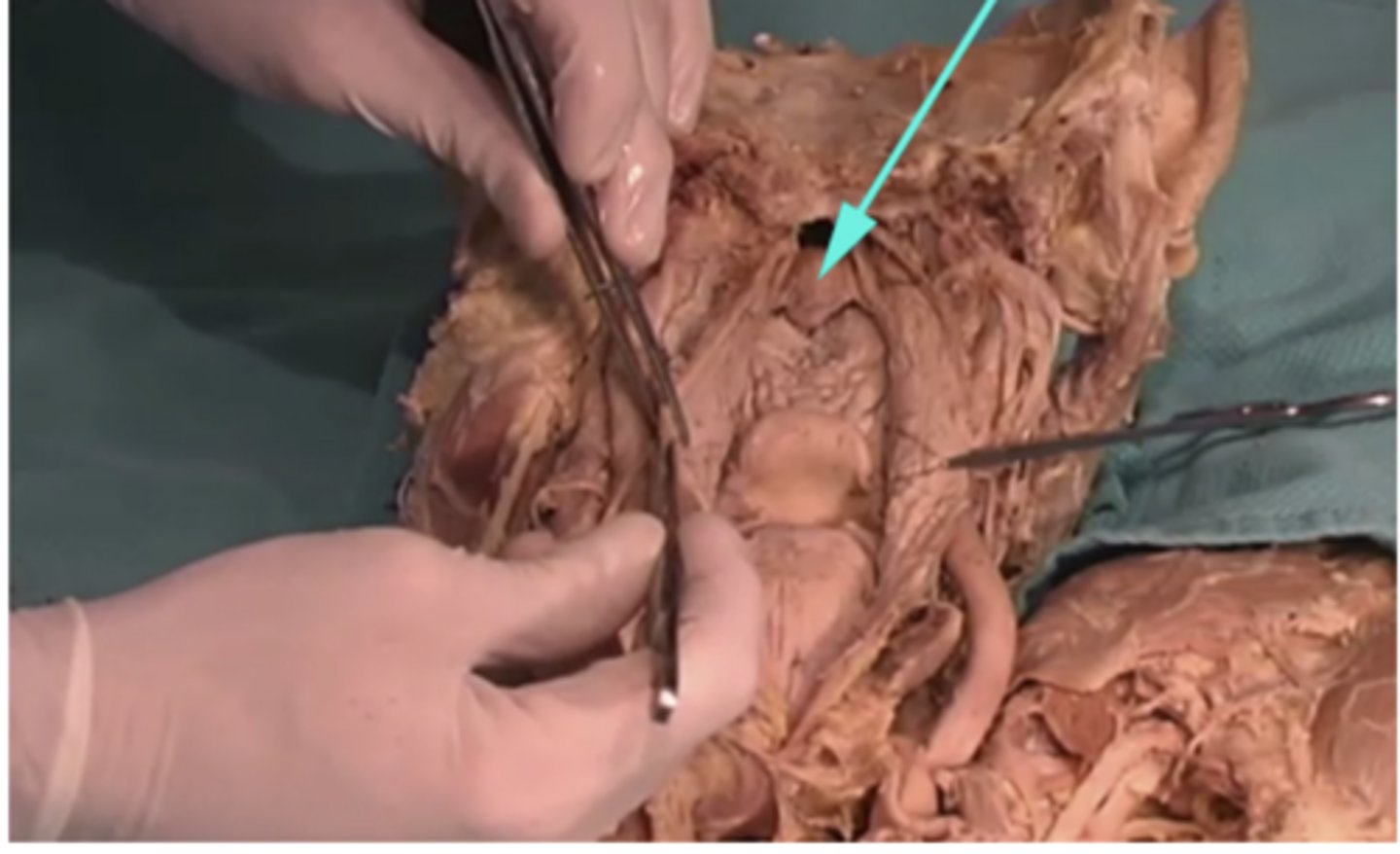 <p>What is the name of this region as indicated by the arrow?</p><p>-mouth</p><p>-buccopharyngeal fascia</p><p>-hard palate</p><p>-soft palate</p>