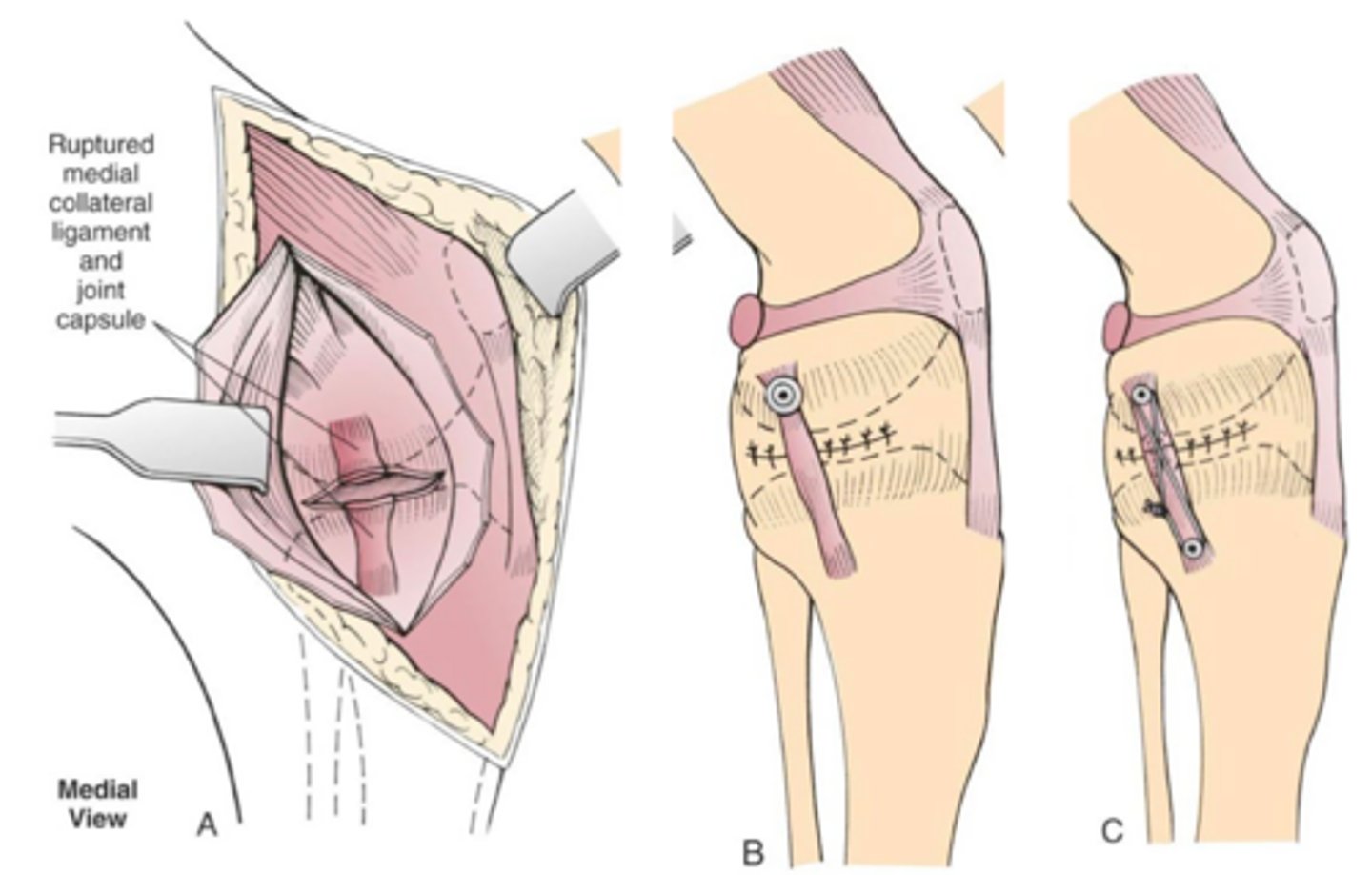 <p>explain general process of repair of medial collateral injury</p>