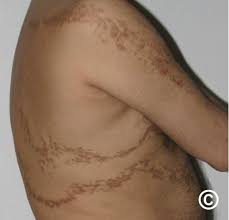 <p>What lesion shape/configuration is this? What condition can cause this?</p>