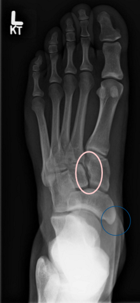 <ul><li><p>more than 1/3 talus head SI by calc</p></li><li><p>intercuneiform joint closed</p></li><li><p>navicular tubercle comes into profile</p></li><li><p>lots of 2-5 MT base SI</p></li></ul><p></p>