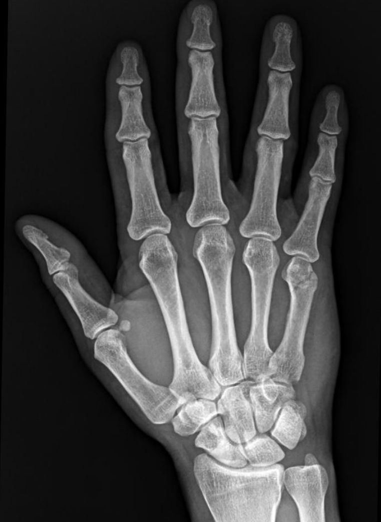 <p>25 y/o male, punched a wall, description?</p>