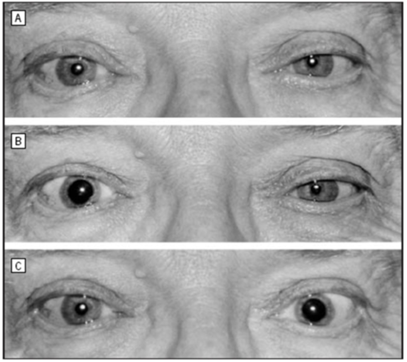 <p>before drops OU = anisocoria greater in dim illumination, OS ptosis</p><p>after cocaine OU = normal OD dilates, abnormal OS remains the same size </p><p>after apraclonidine OU = normal OD does not dilate, abnormal OS dilates = reversal of anisocoria = positive test</p>