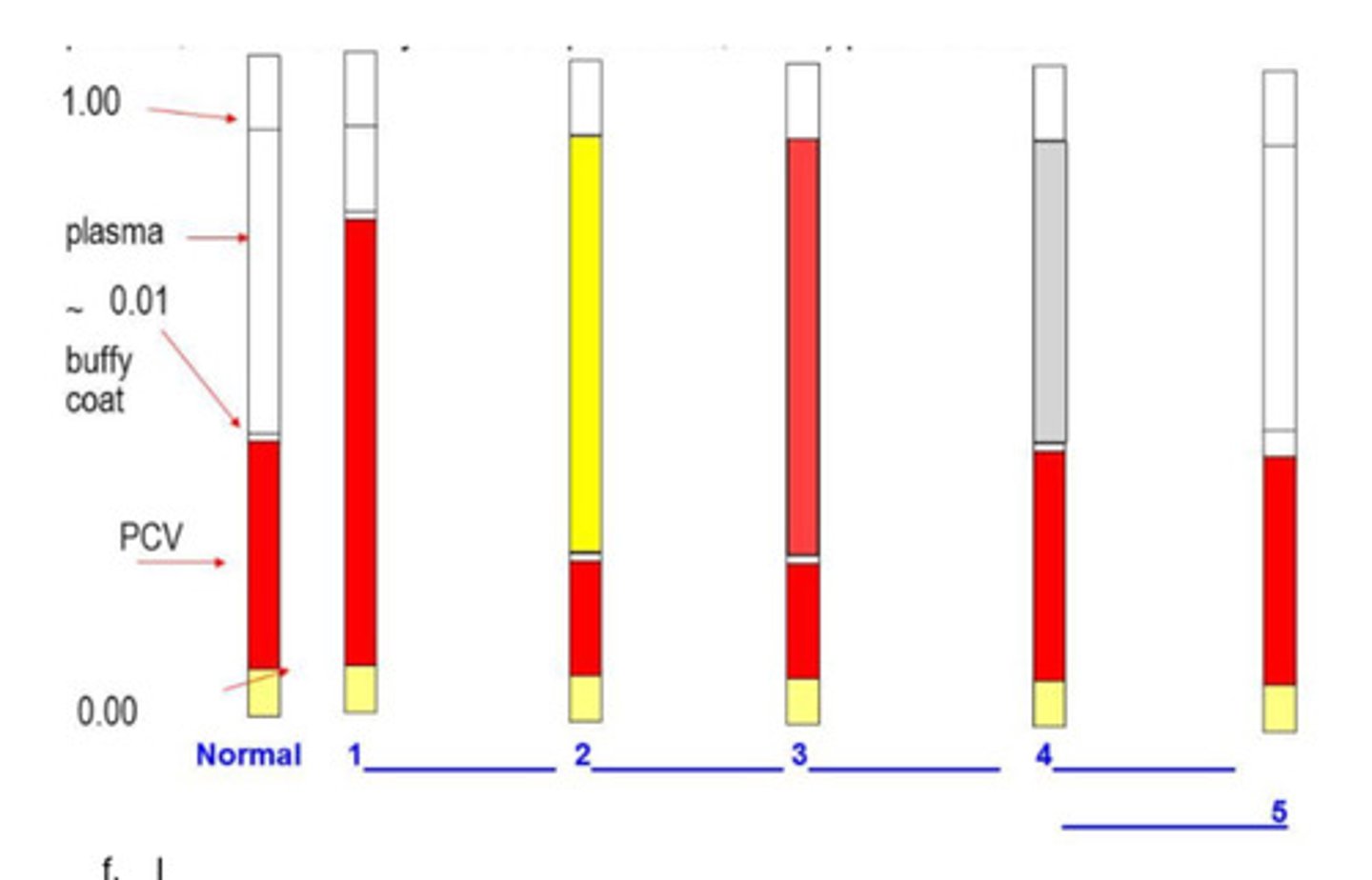 <p>Whichof the microhaematocrit tubes best indicates chronic systemic inflammation?</p>