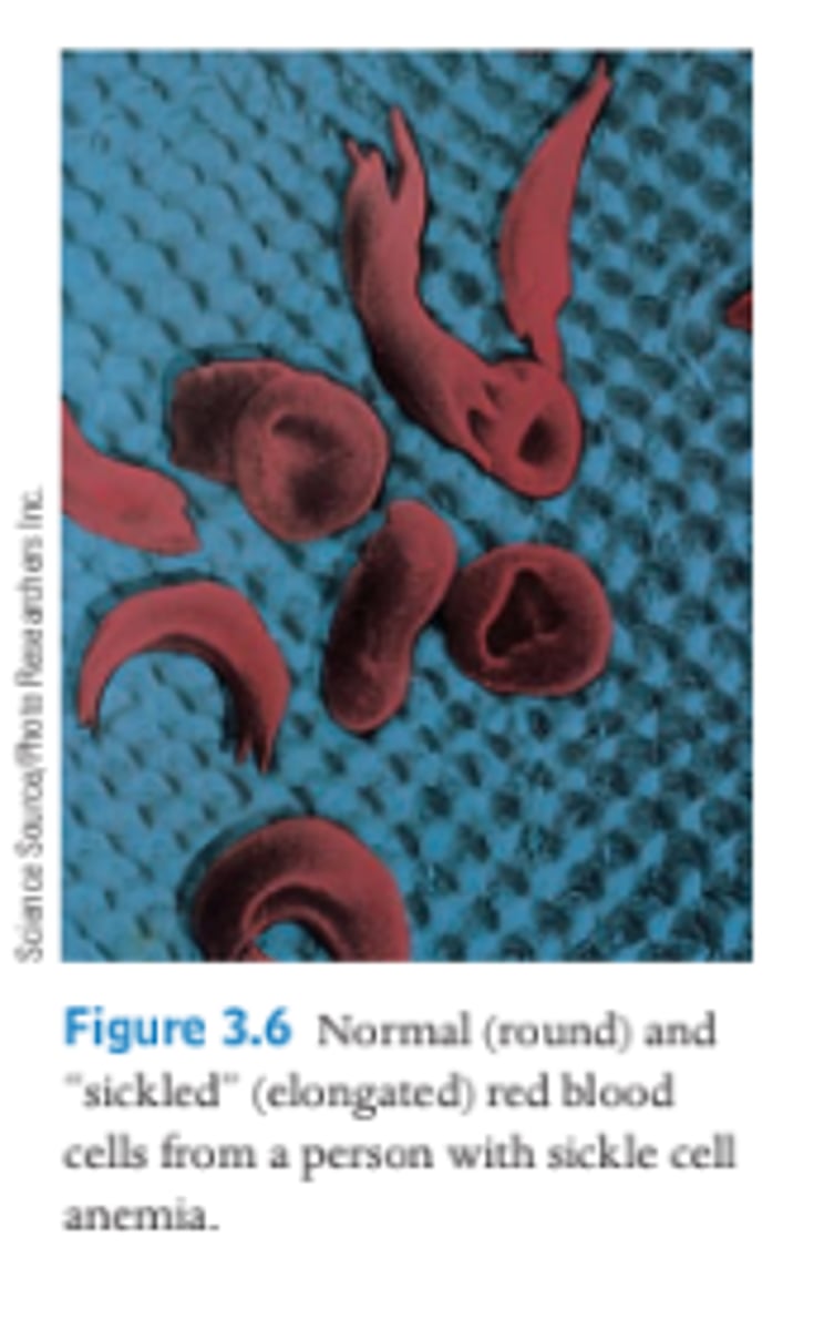 <p>The sickle cell trait, where a heterozygous person has some red blood cells with a sickle shape due to the presence of one sickle-cell allele.</p>