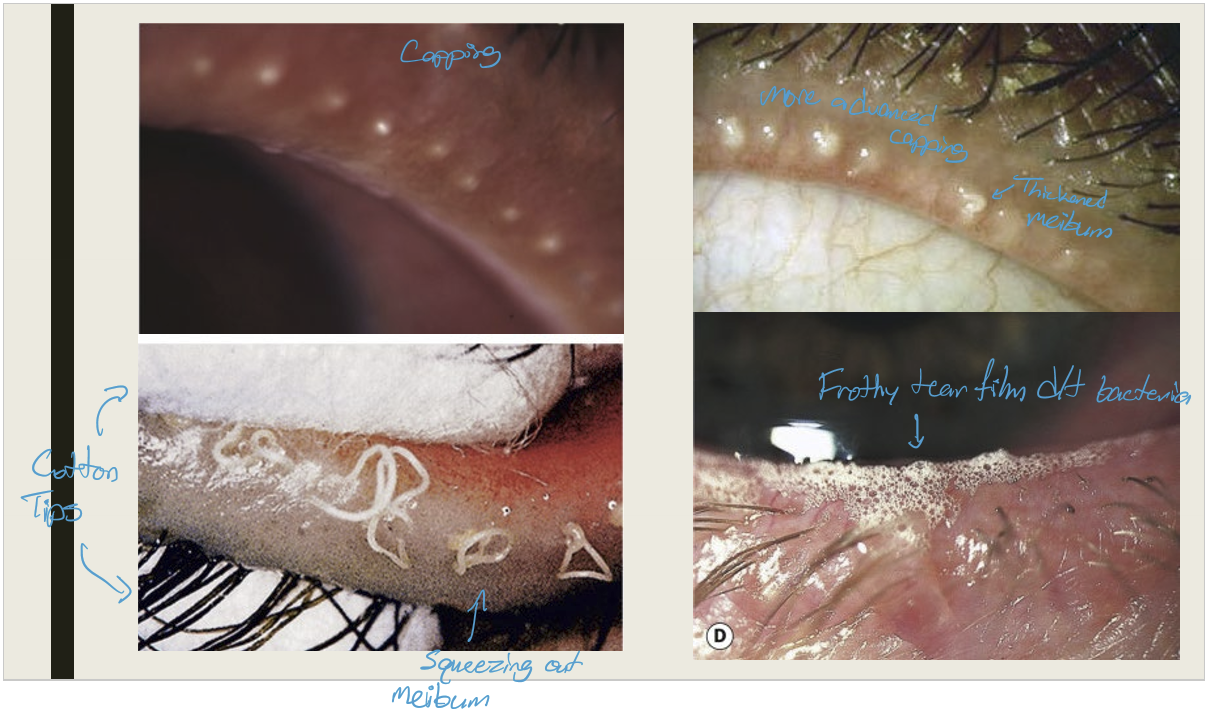 <p>Symptoms:</p><ul><li><p>Chronic irritation worse in AM;</p></li><li><p>Burning, grittiness, photophobia, &amp; crusting</p></li></ul><p>Presentation:</p><ul><li><p>Capping of meibomian glands;</p></li><li><p>thickened meibum w/ meibomian gland expression;</p></li><li><p>lid hyperemia and telangiectasia;</p></li><li><p>Permanent gland loss</p></li><li><p>frothy or oily tear film</p></li></ul><p></p>