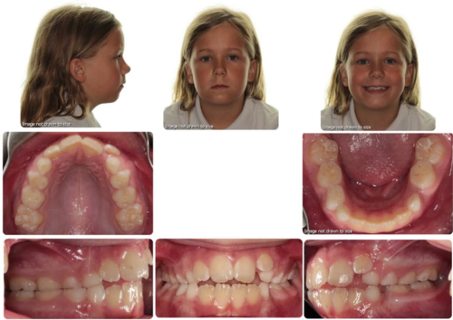 <p>There is a procedure called "serial extraction," which is done if the patient has more than 8 mm of crowding and is Class I molar relation. Let's say we do a mixed dentition analysis and find that this patient has 4 mm of crowding.</p><p>Should we do serial extraction on her?</p>