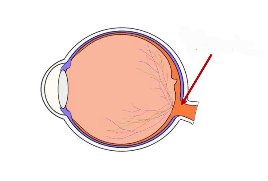 <p>the raised disk on the retina at the point of entry of the optic nerve, lacking visual receptors and so creating a blind spot.</p>