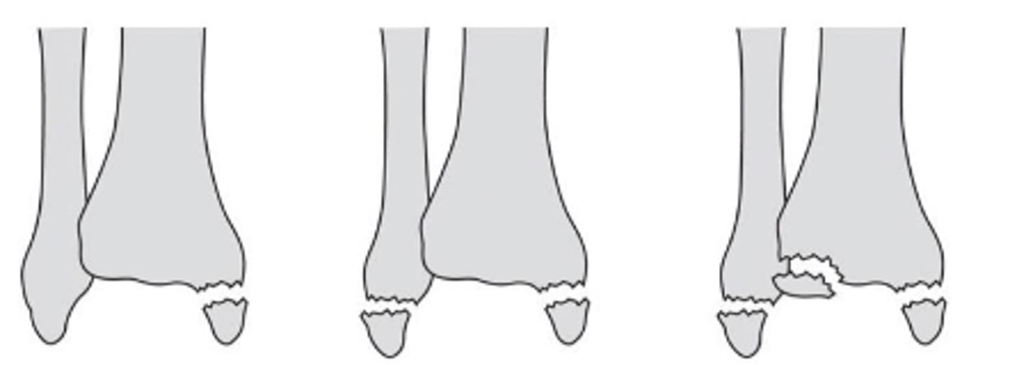 <p>- unimalleolar<br>- bimalleolar<br>- trimalleolar (malleoli and posterior rim tibia)</p>