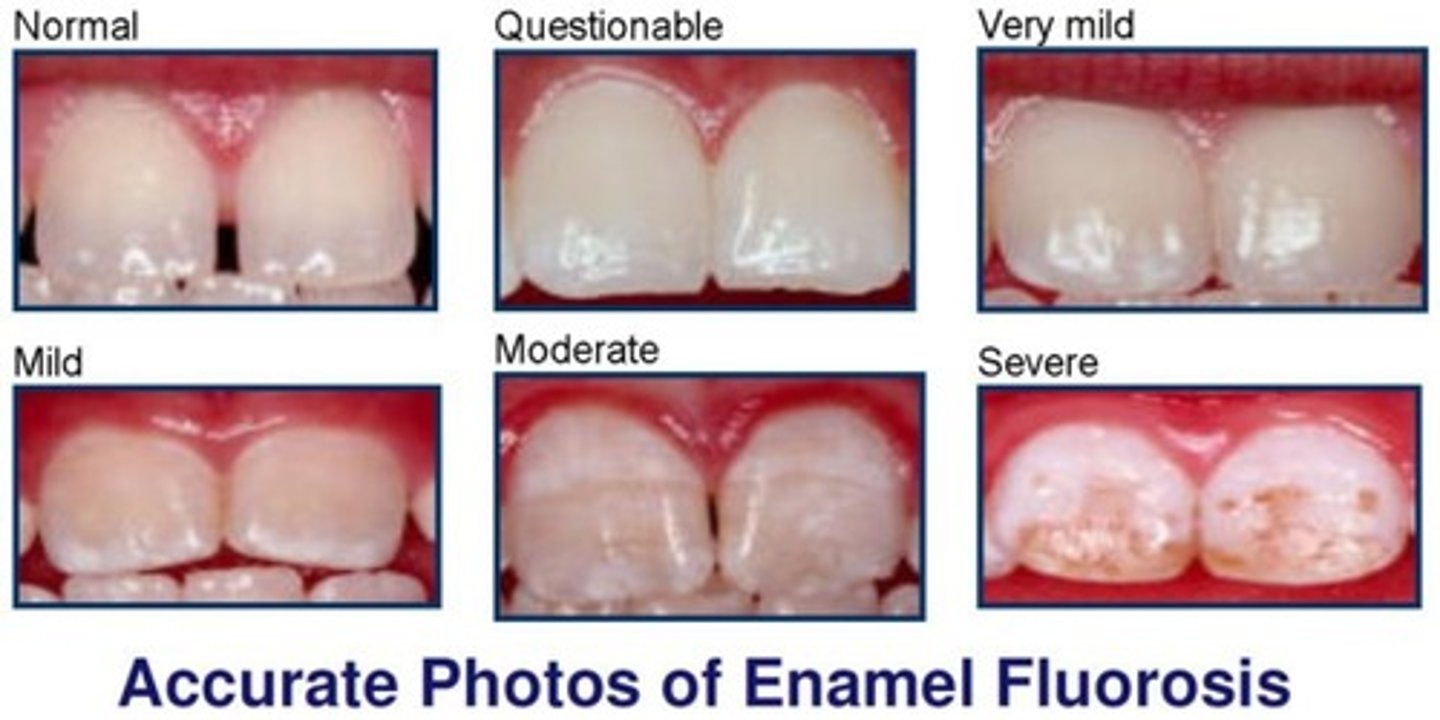 <p>The Fluorosis Index measures the severity of dental fluorosis. The score is based on the two most affected teeth and ranges from normal enamel to severe fluorosis.</p>