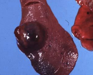 <p>Which neoplasia is found in the spleen and heart and has multiple red masses defined by sheets of endothelium?</p>