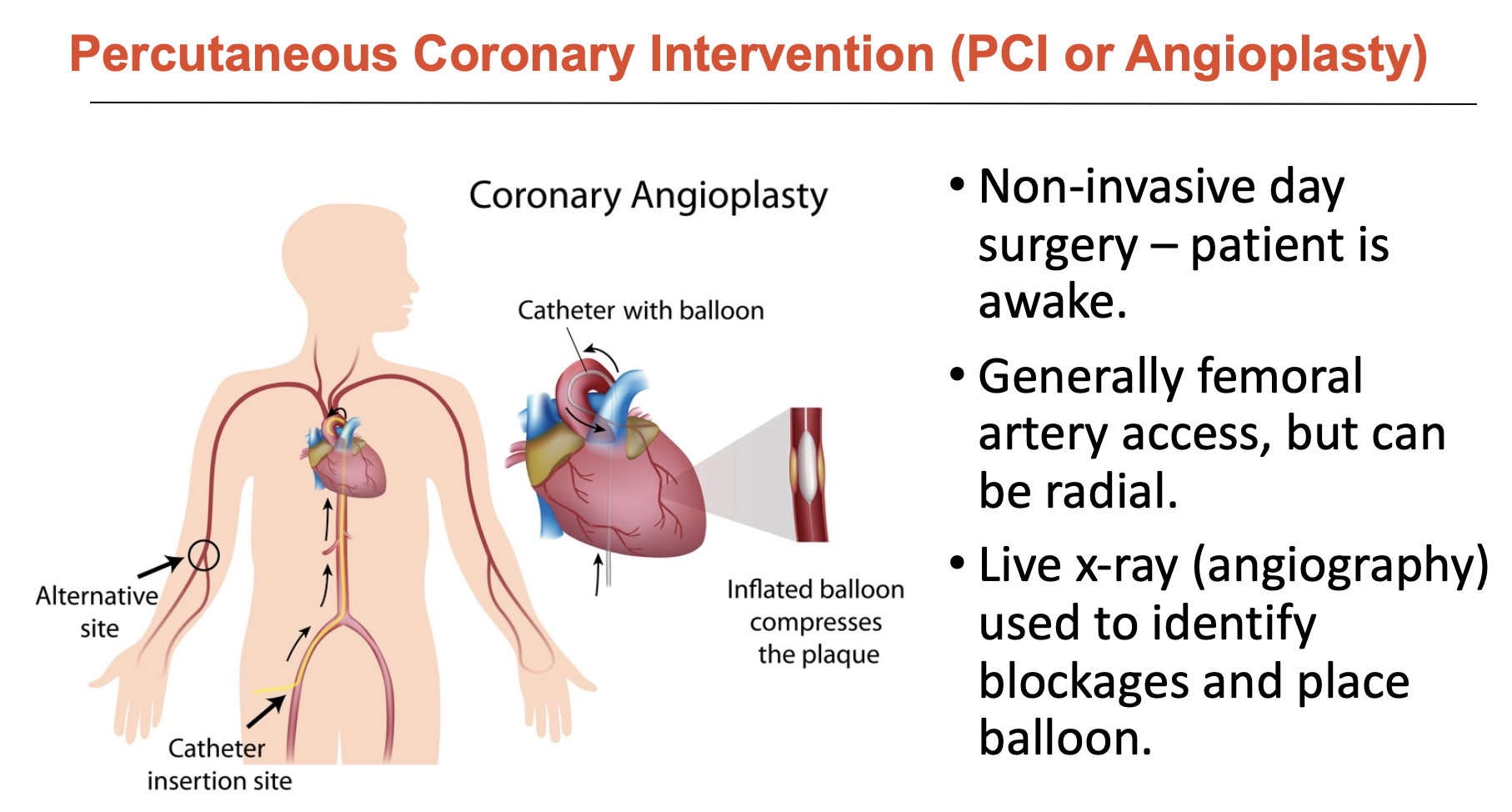 <p>Alternative to coronary artery bypass, PCI is a non-invasive day surgery</p><ul><li><p>generally femoral artery access, but can be radial</p></li><li><p>live x-ray (angiography) used to identify blockages and place balloon</p><ul><li><p>however, blockages in mild disease can be subtle and the link between angiogram and lesion is not always clear</p></li></ul></li></ul><p></p>