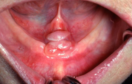 <p>a benign fibrous hyperplasia caused by irritation, often seen in edentulous (no teeth)  patients. </p>