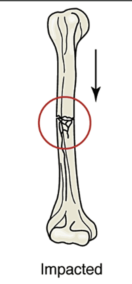 <p>bone is forcibly pushed together, resulting in bone being pushed into bone</p>