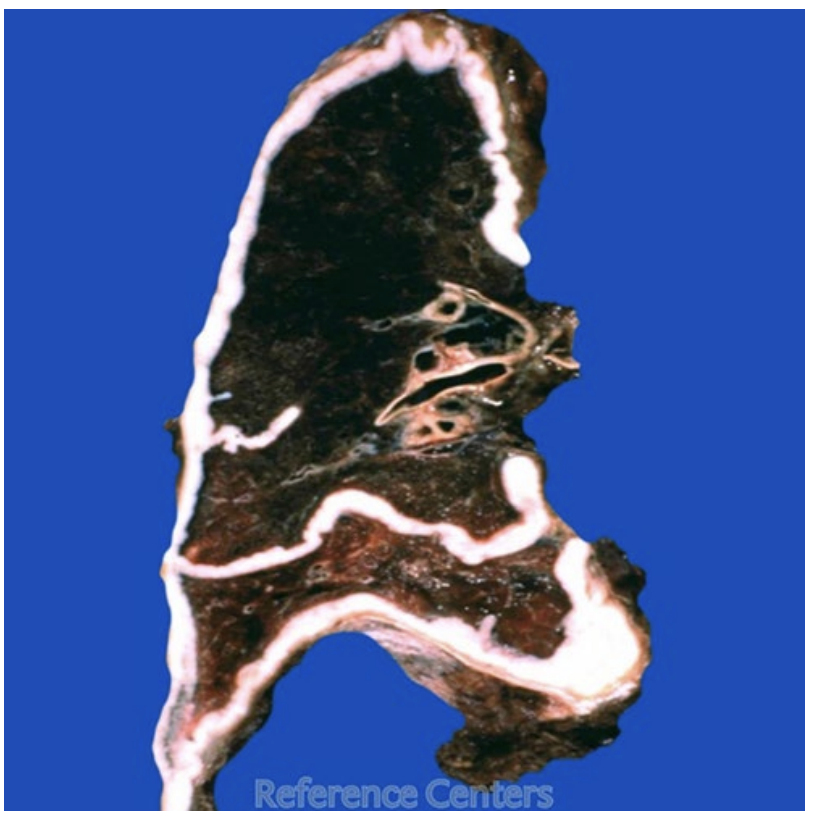 <p>A 72-year-old male has had increasing dyspnea for the past year. Decreased breath sounds are heard on auscultation of the right side of the chest. A chest radiograph shows a large pleural mass that nearly encases the right lung. The representative gross appearance of his lung is shown in the attached figure. A pleural biopsy specimen shows a malignant neoplasm. Exposure to which of the following is associated with these findings?</p>