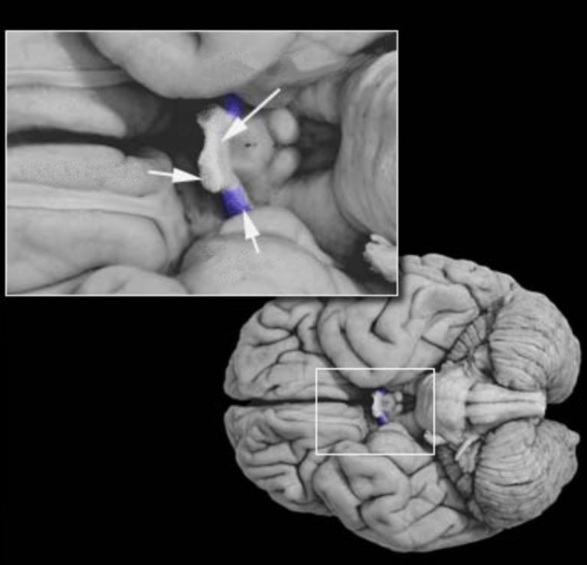 <p>Optic tract</p>
