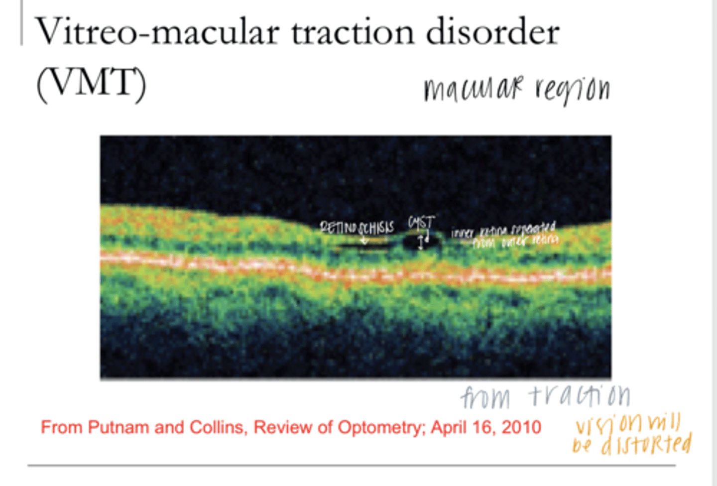 <p>Describe Vitreomacular Traction (VMT)</p>