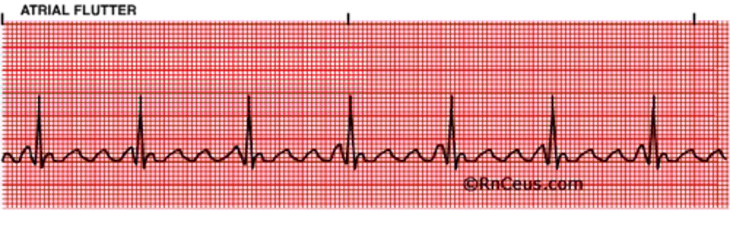 <p>ATRIAL FLUTTER</p>