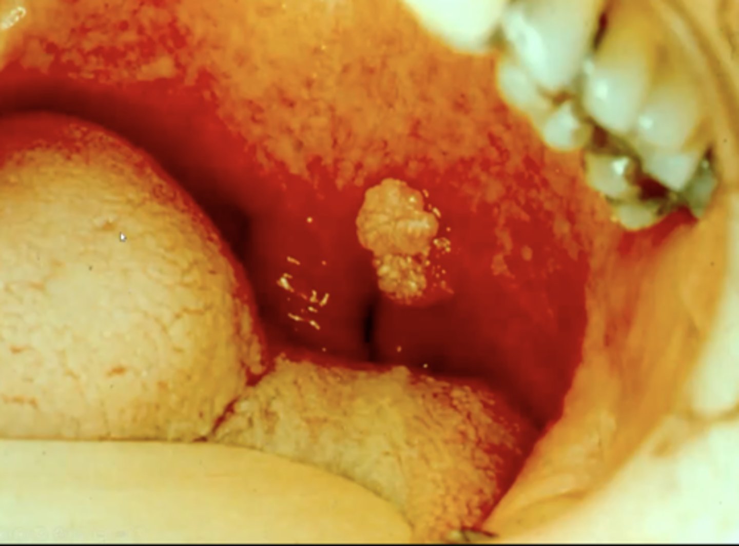 <p>a benign, papillary projection of any shape (looks like a little cauliflower sticking out)</p><p>there will commonly be hyperparakeratosis and acanthosis present </p>