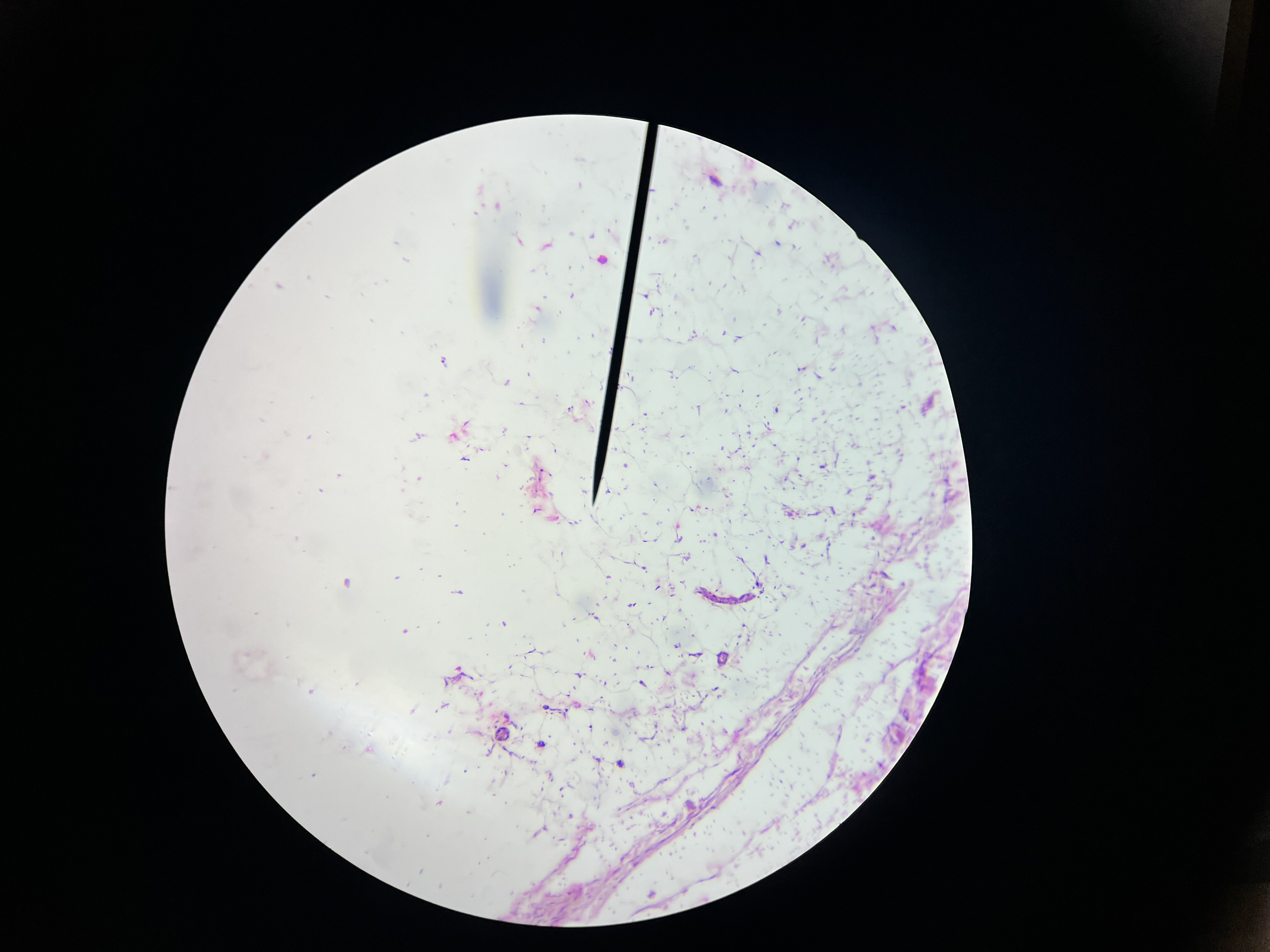 <p>A benign tumor composed of fatty tissue that occurs in the breast.</p><p>Histomorphologic findings: Typically include a well-circumscribed mass composed of mature adipocytes (fat cells) with a fibrous capsule, and no signs of malignancy.</p>