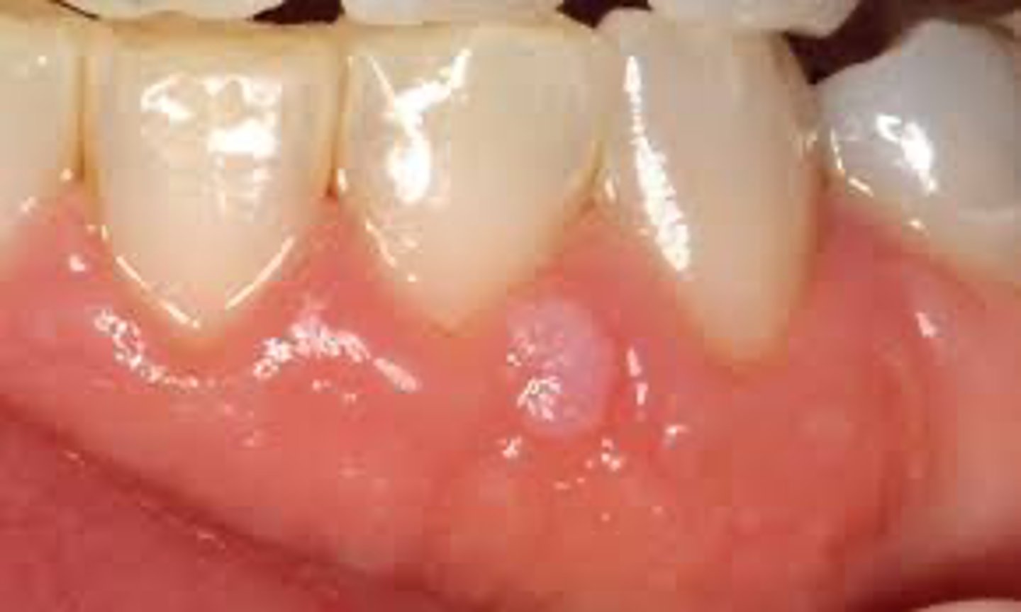 <p>A small, white, rough lesion on the gingiva of a child who bites their nails is most likely:</p>