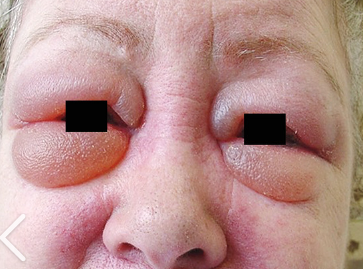 <p>= lids are swollen and puffy; excess fluid is easily apparent</p>