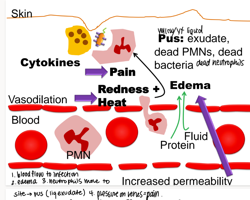 <ol><li><p>exudate </p></li><li><p>dead neutrophiles/ PNMs </p></li><li><p>dead bacteria </p></li></ol><p>(exudate is any fluid that OOZES out of tissues) </p>
