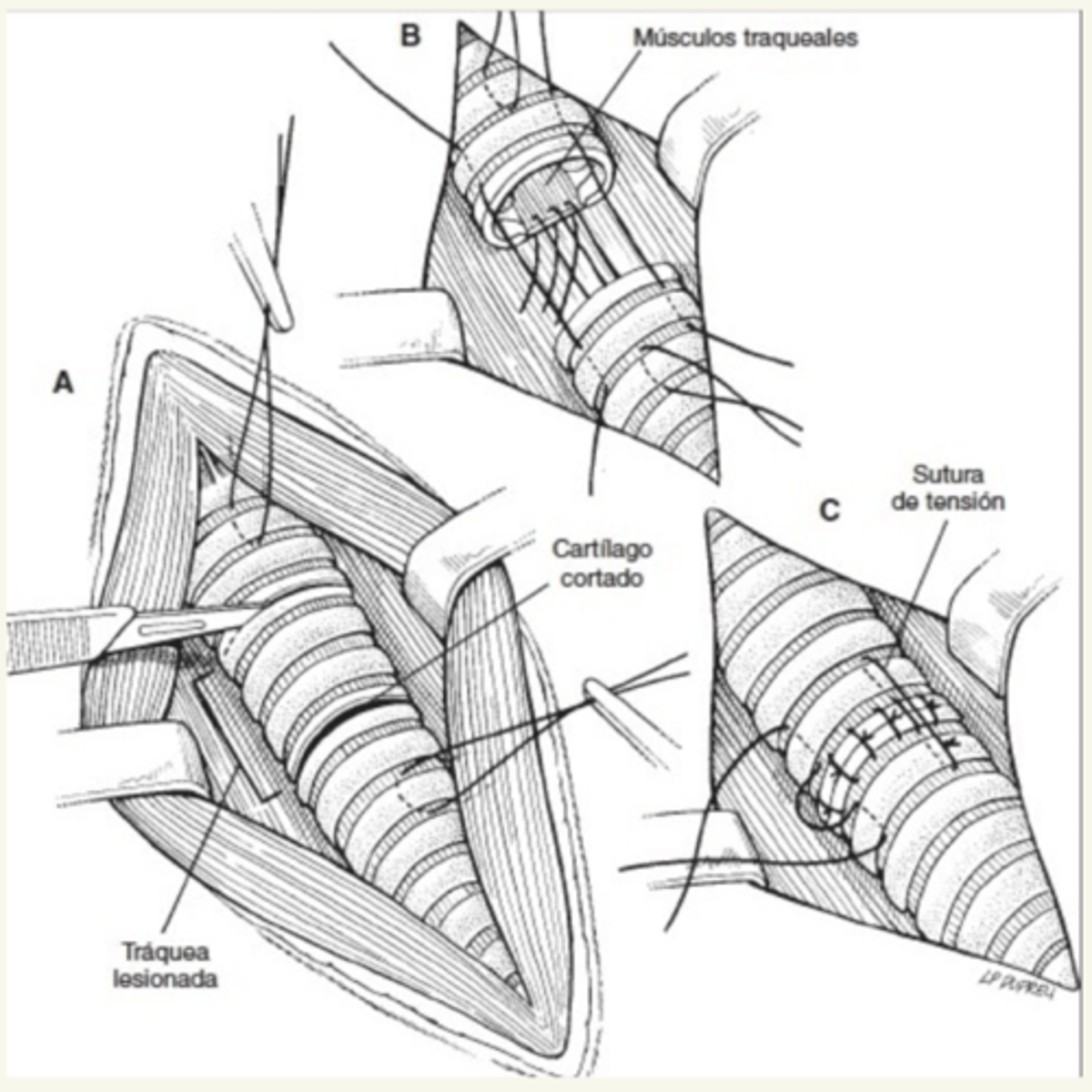<p>anastomosis (traqueorrafia) de las partes</p>