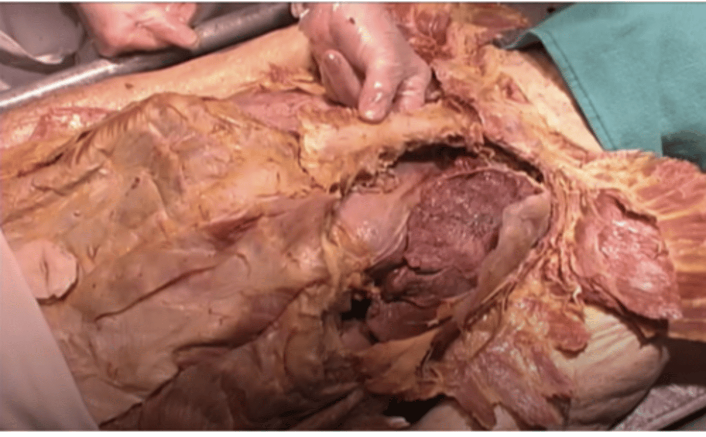 <p>What is the structure here in between the fingers?</p><p>clavicle</p><p>rib</p><p>parietal pleura</p><p>sternum</p>