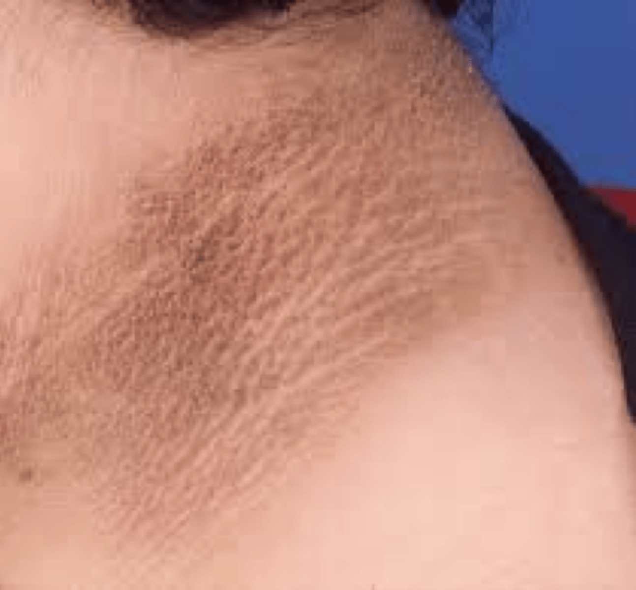 <p>-<strong>Acanthosis nigricans </strong></p><p>-features of <strong>hyperandrogenism</strong> (<em>thin or muscular body habitus or acral enlargement)</em></p>