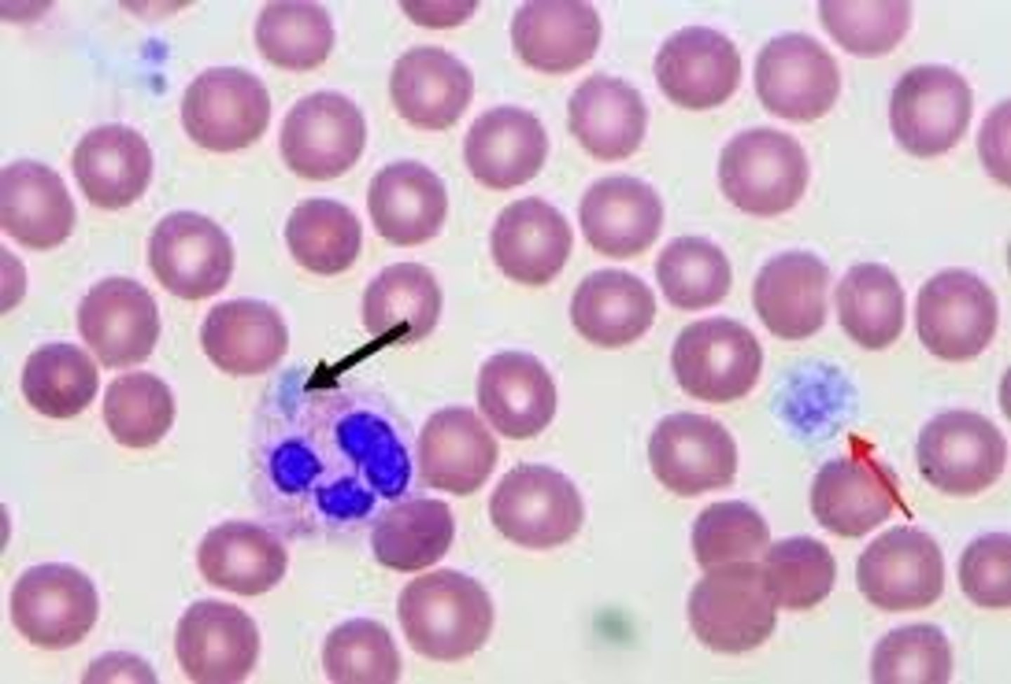 <p>Giant platelets, large dohle body like inclusions within neutrophils, eosinophils, basophils, and monocytes</p>