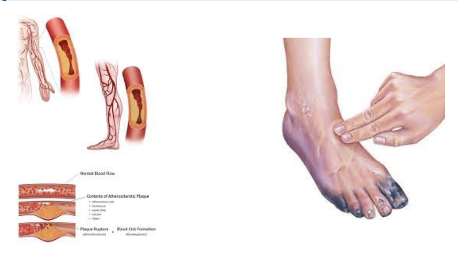 <p>-lack good blood flow to arms, legs, and vital organs</p><p>-skin lost and amputations</p><p>-exercise Rx like CV or Type II diabetes</p>