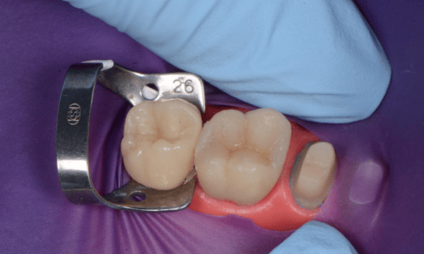 <p>What should be placed in the vestibule (under the thumb)?</p>