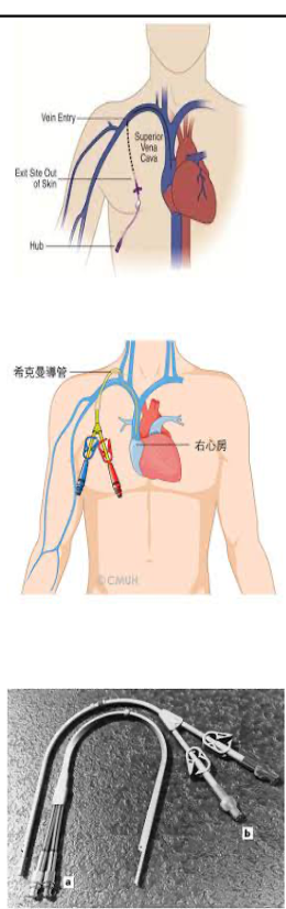 <p>long thin hollow tube<br>for fluids, meds, hemodialysis, draw blood<br>long-term use</p>