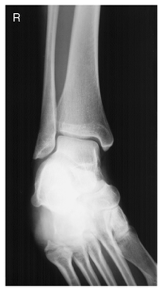 <p>- Intermalleolar line parallel to IR</p><p>- Ankle rotated 15-20 degrees medial rotation</p><p>- CR midway between malleoli</p><p>- Entire ankle mortise open</p><p>- Distal ⅓ of tibia and fibula demonstrated</p><p>- Proximal ½ of metatarsals included</p><p>- Optimal exposure factors</p>