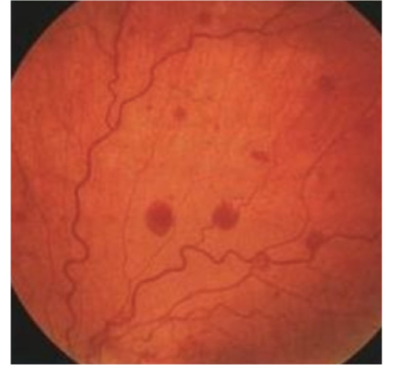 <p>Dot or blot hemorrhages</p>