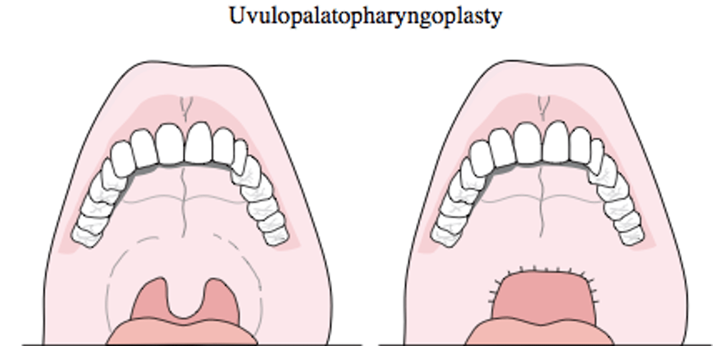 <p>Uvulopalatopharyngoplasty</p>