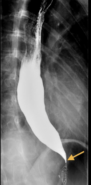 <p>45 y/o male presents to the clinic for dysphagia that has worsened over the past few months.  He notes that he tends to feel “full in the chest” after eating, and has been vomiting several hours after the meal. He states that he has loss 30 lbs in the last few months. On a barium swallow study you notes a bird’s beak tapering and on esophageal manometry notes the complete absence of peristalsis. Let’s say he’s a low risk surgical patient, what is your treatment plan?</p>