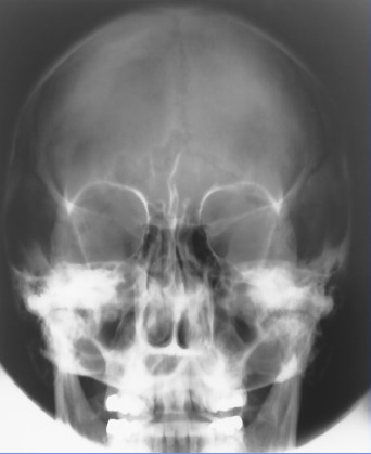 <p>What is this x-ray demonstrating?</p>