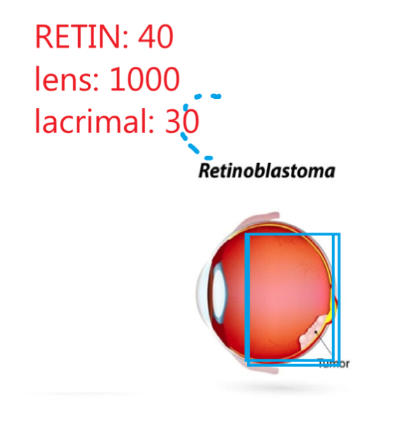 <ol><li><p>Dose: 40Gy</p></li><li><p>Field arrangement: </p><ol><li><p>Various oblique fields (to avoid txing lens) </p></li><li><p>IMRT- better</p></li></ol></li><li><p>Lens- 1000cGy</p></li><li><p>lacrimal glands- 30 Gy</p></li></ol><p></p>