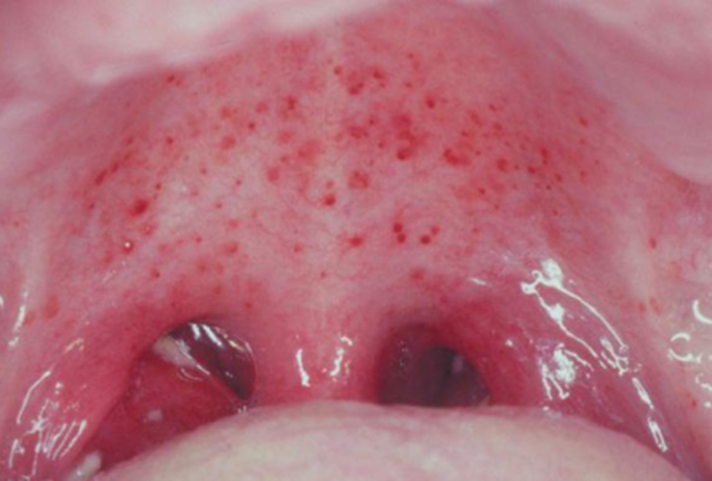 <p>infectious mononucleosis</p>
