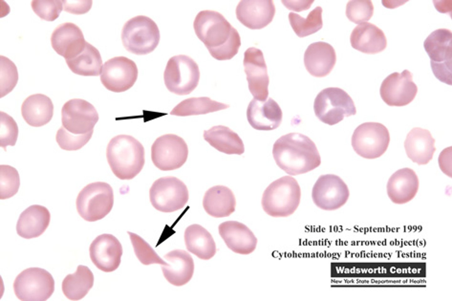 <p>Sickle shaped cells of angora goats and sheep. Thought to be an in vitro phenomenon caused by high oxygen tension</p>