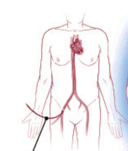 <p>-it treats arrhythmias by destroying part of the heart’s electrical conduction system or a dysfunctional area of cardiac muscle using heat from high-frequency alternating current (350–500 kHz).</p><ol><li><p>A catheter is inserted through a vein into the heart</p></li><li><p>Performed in hospital under local anaesthesia or mild sedation</p></li><li><p>Lasts about 4 hours</p></li><li><p>Guided by real-time X-ray fluoroscopy</p></li></ol><ul><li><p>Usually very successful, especially if the abnormal focus is clearly identified beforehand</p></li></ul><p></p>