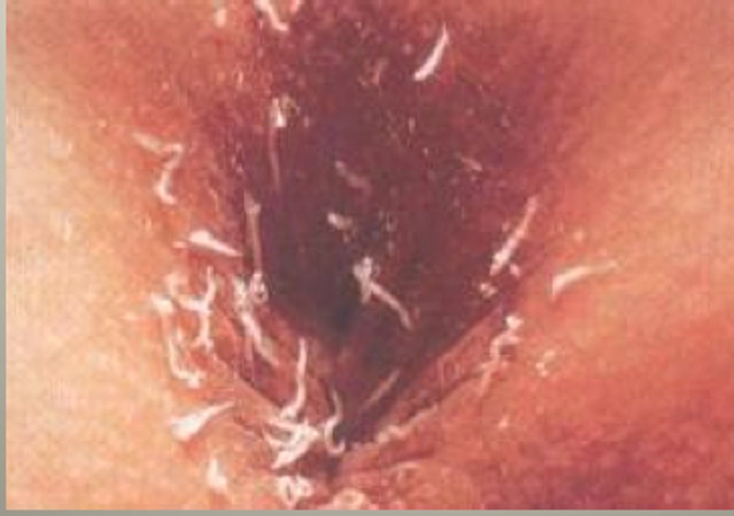 <p>Method to diagnose pinworm by placing tape on the rectum to look for eggs/larvae.</p>