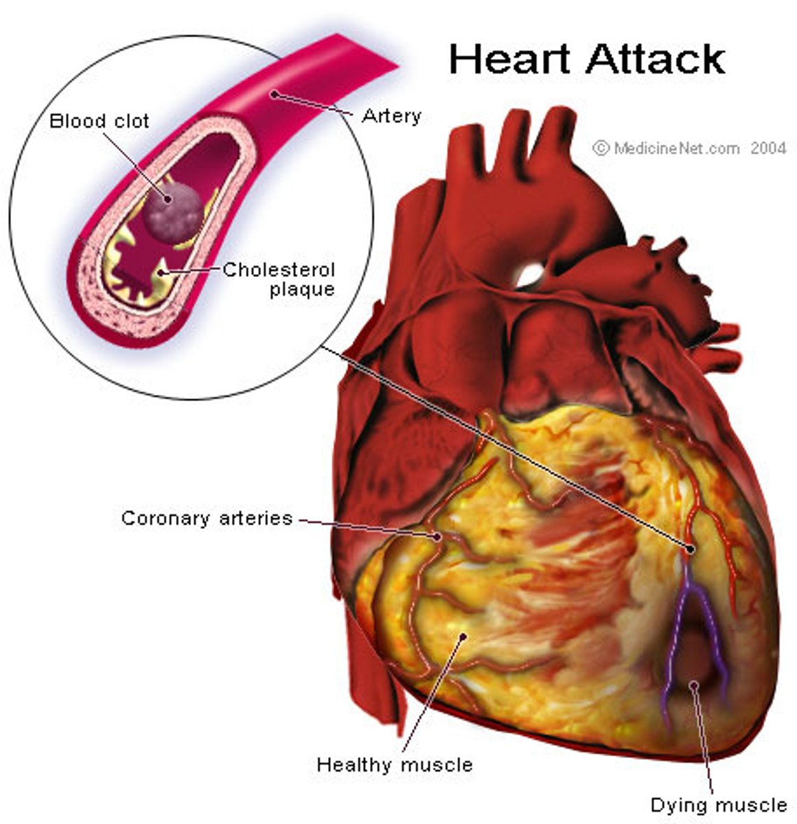 <p><strong>heart attack</strong></p><p>-caused by lack of oxygen to part of the heart(blockage)</p>