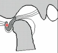 <p>disc is displaced and STAYS displaced</p>