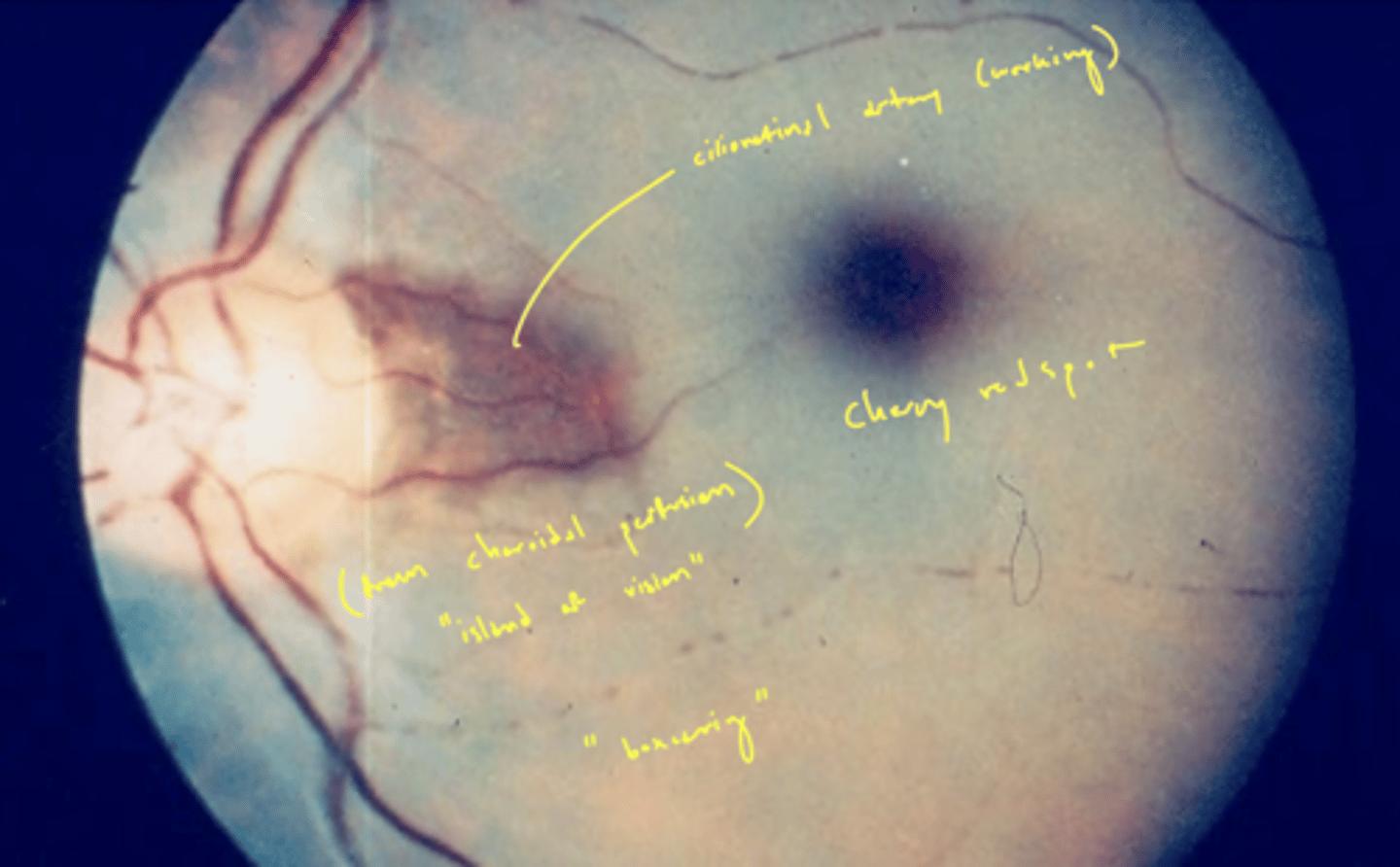 <p>if they have a cilioretinal artery</p>