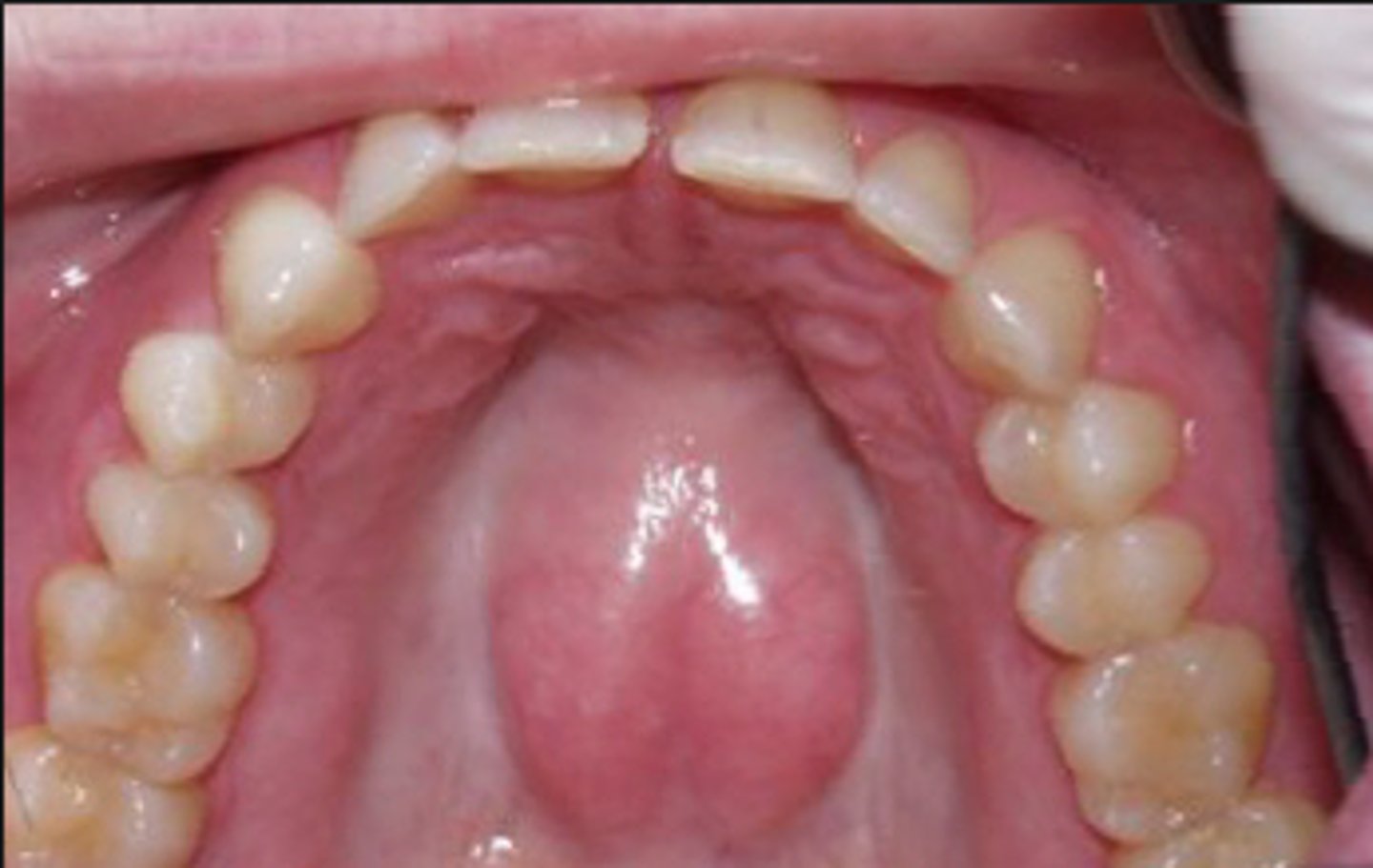 <p>normal variation of bony growth at the midline of the hard palate</p>