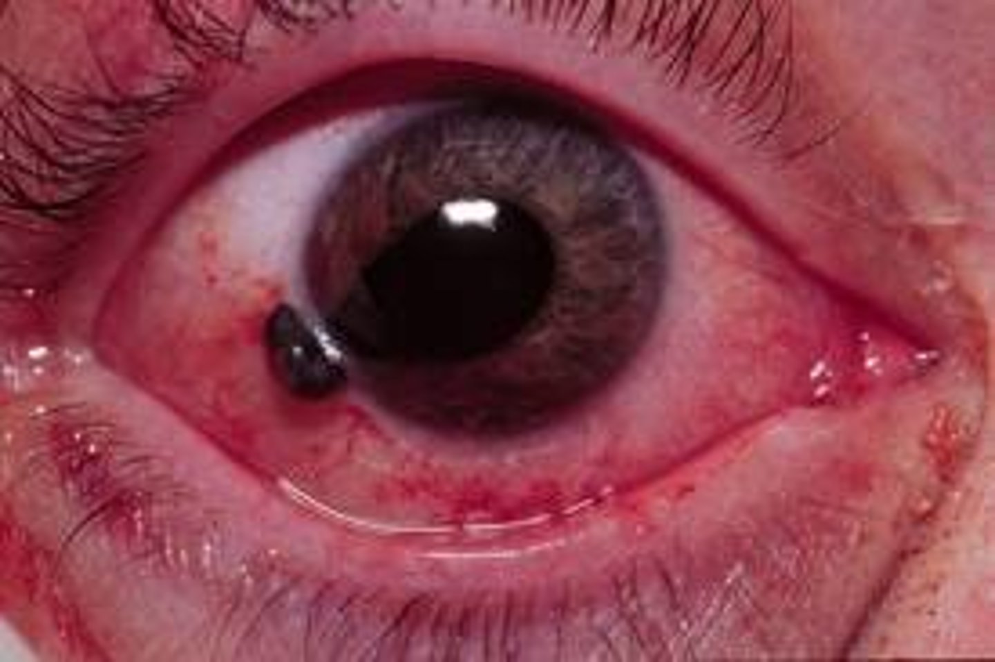 <p><span><u>Etio</u></span>: blunt<strong> penetrating</strong> trauma causing laceration of globe</p><p><span><u>S&amp;S:</u></span> Severe pain, <strong>decreased VA</strong>, tear in cornea</p><p><span><u>Tx</u></span>: emergent referral, avoid putting drops into eye, avoid removing any objects; PAIN: IV morphine 0.1 mg/kg, <strong>NO NSAIDS</strong>, lorazepam 0.05 mg/kg, tetanus prophylaxis</p>